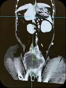 牛牛鼻腔肿瘤CT冠状面影像显示鼻腔占位与骨溶解
